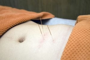 Acupuncture and Dry Needling